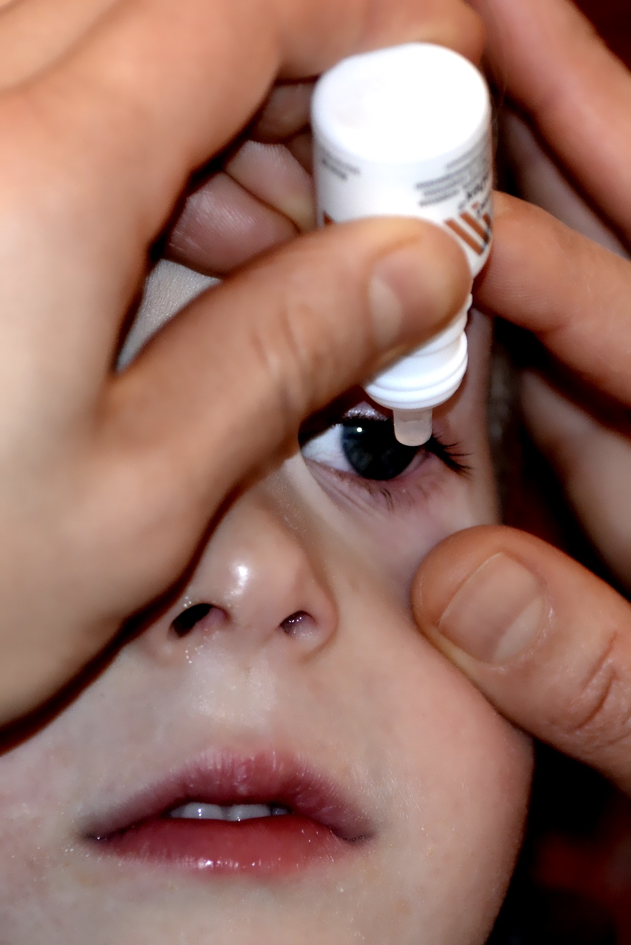 Augenallergie Behandlung Optik Weißmann Oberaudorf Brille kaufen Therapie H1-Blocker Augentropfen